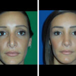 Before and After Revision Rhinoplasty Houston