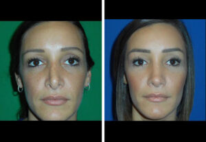 Before and After Revision Rhinoplasty Houston