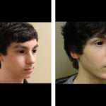 Teen Rhinoplasty Before and After houston