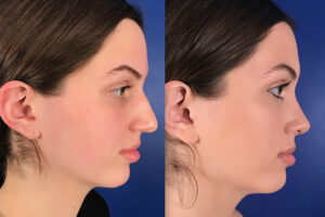 Dr Ben Cilento Rhinoplasty Houston