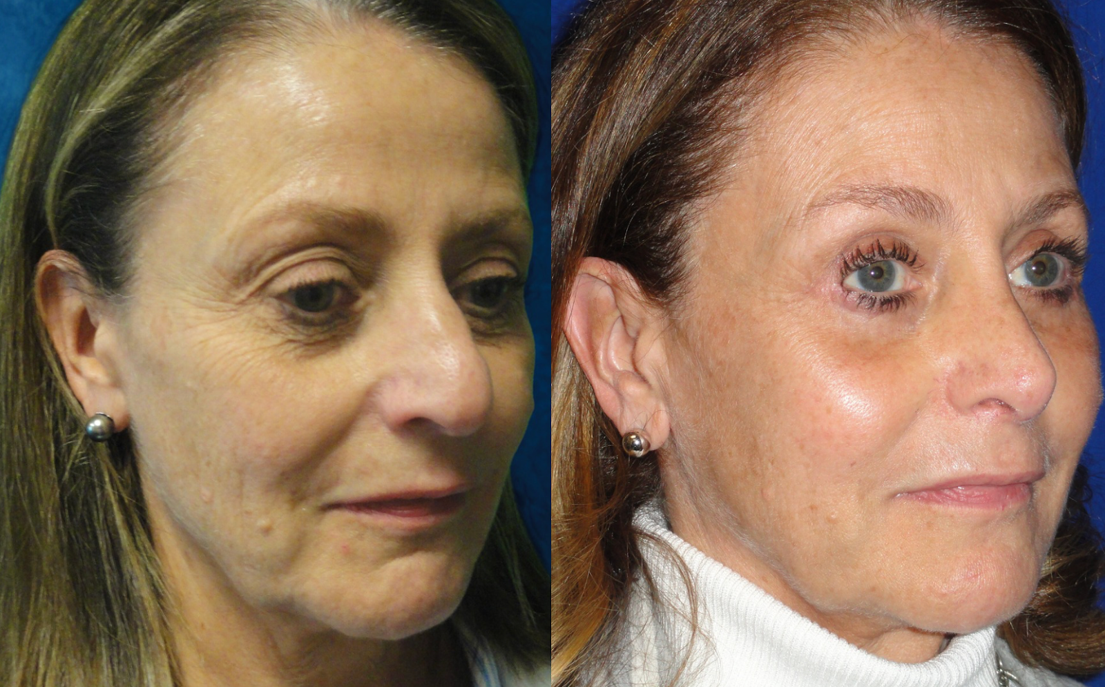 Anti-Aging Efforts | Get Juvederm